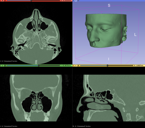 Nasal CFD Geometry